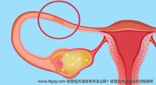 试管短方案成功率怎么样？试管短方案的治疗过程解析