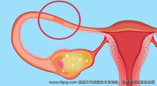 美国三代试管技术受热捧，生育愿望成优选动因