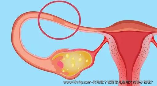 北京做个试管婴儿费用大约多少钱呢？