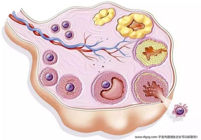 子宫内膜增生过长可以试管吗？