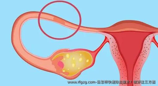 后怎样快速排出腹水？做好这三方面