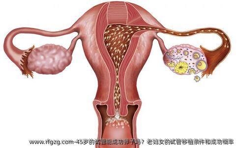 45岁的试管能成功卵子吗？老妇女的试管移植条件和成功概率